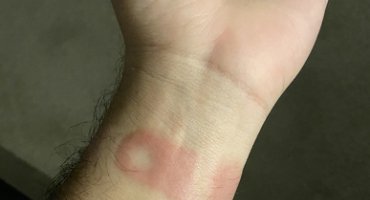 "Было больно": пользователи Аpple Watch жалуются на повреждение кожи